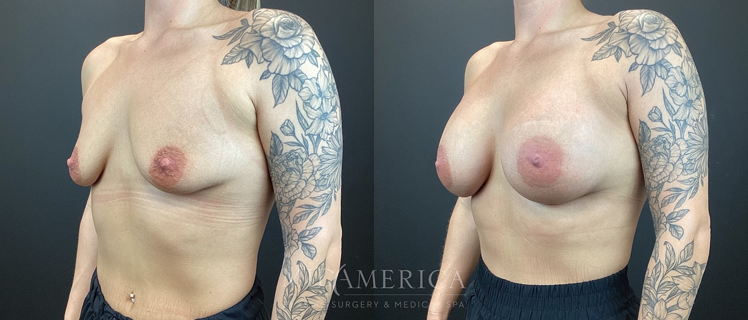 Breast Augmentation Before & After