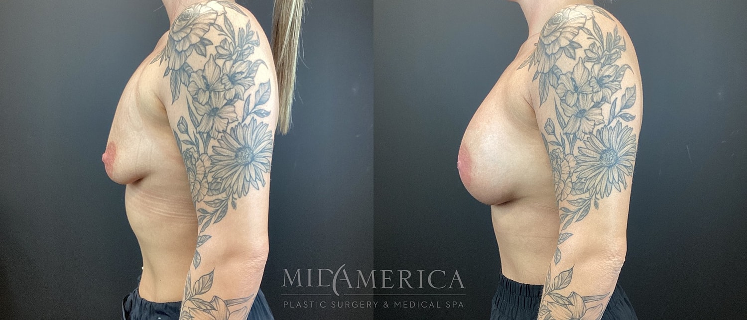 Breast Augmentation Before & After