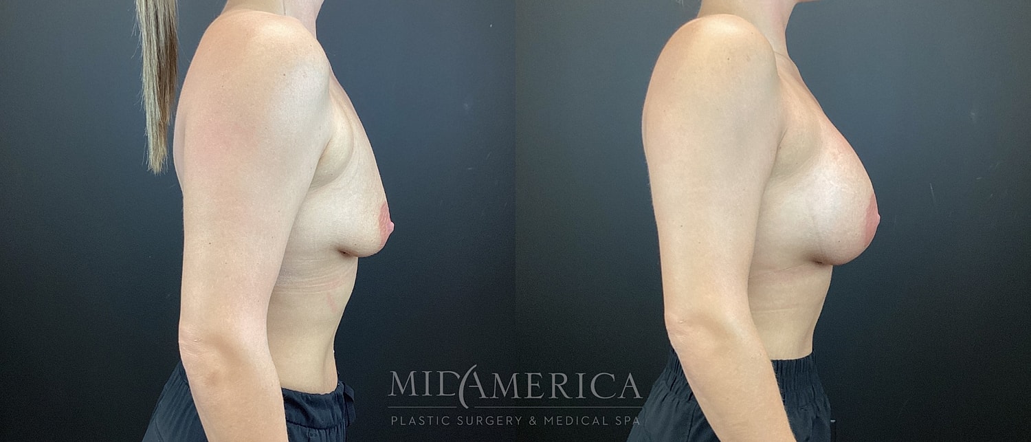 Breast Augmentation Before & After