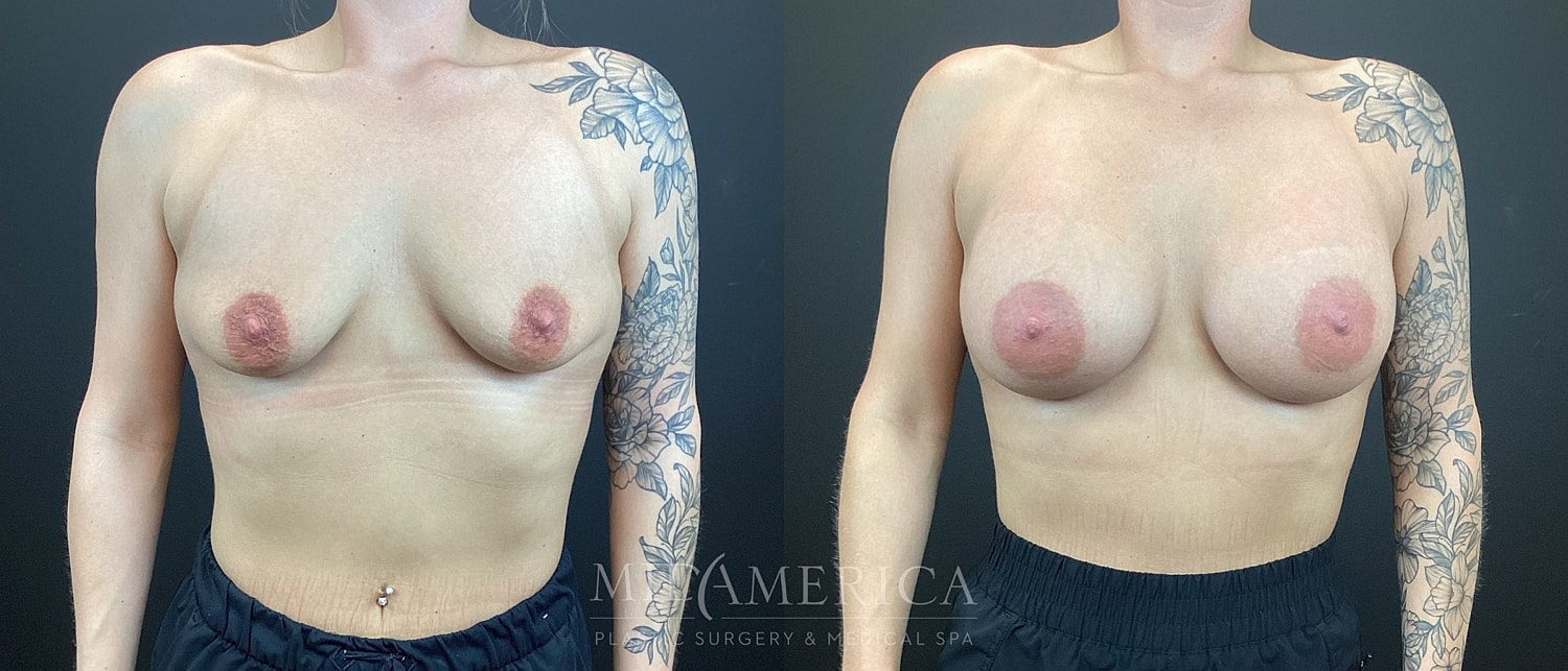 Breast Augmentation Before & After