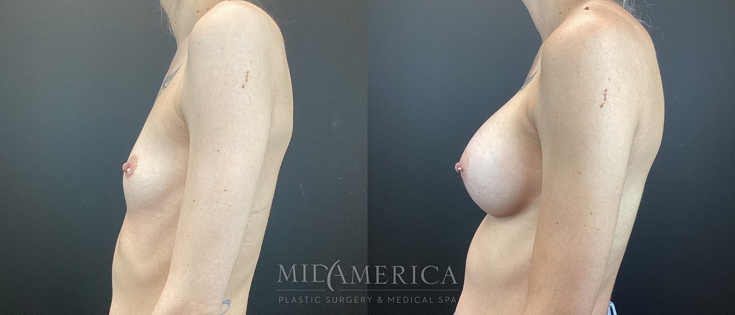 Breast Augmentation Before & After