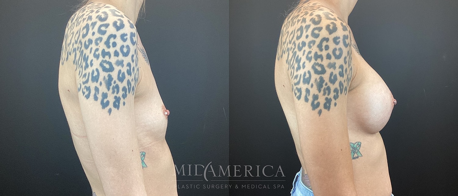 Breast Augmentation Before & After