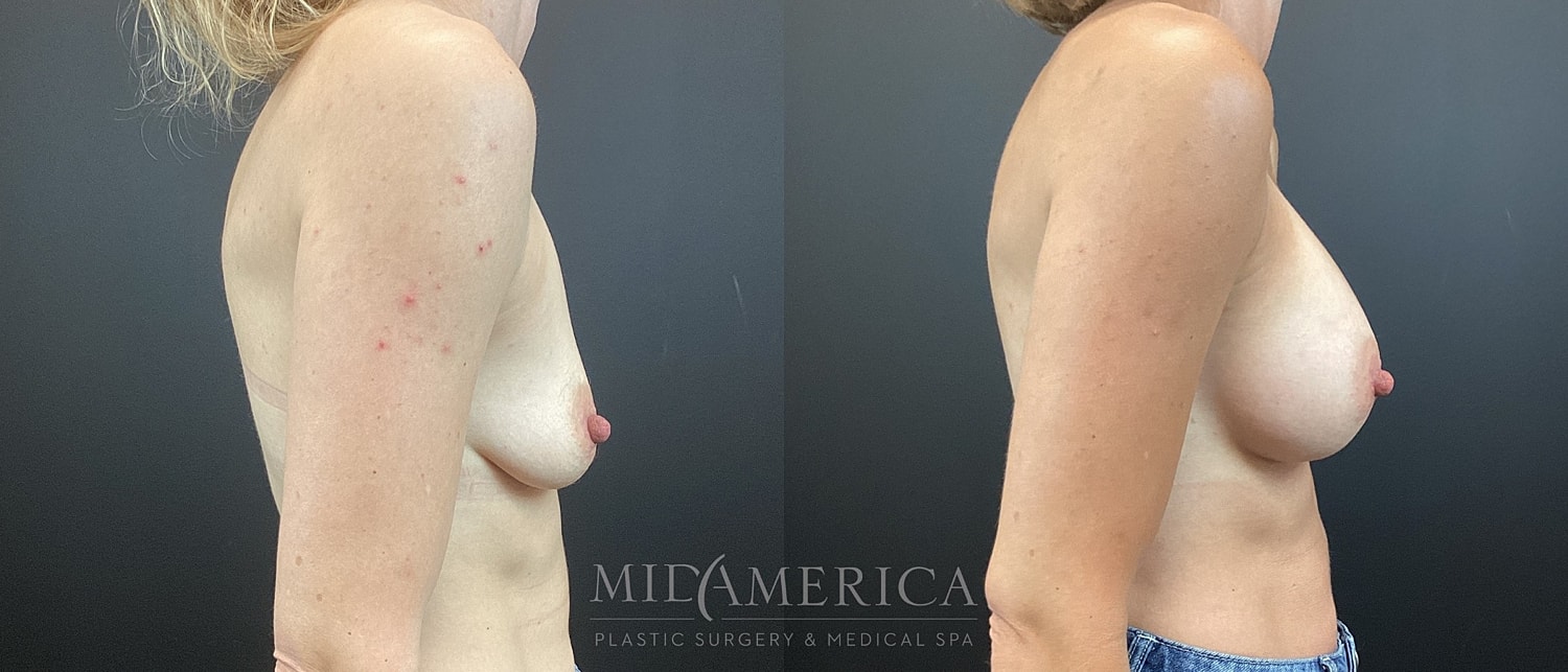 Breast Augmentation Before & After