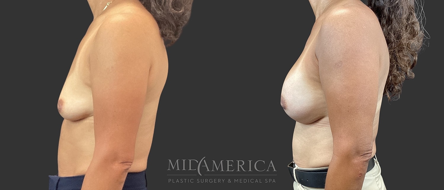 Breast Augmentation Before & After