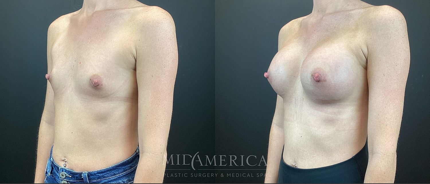 Breast Augmentation Before & After