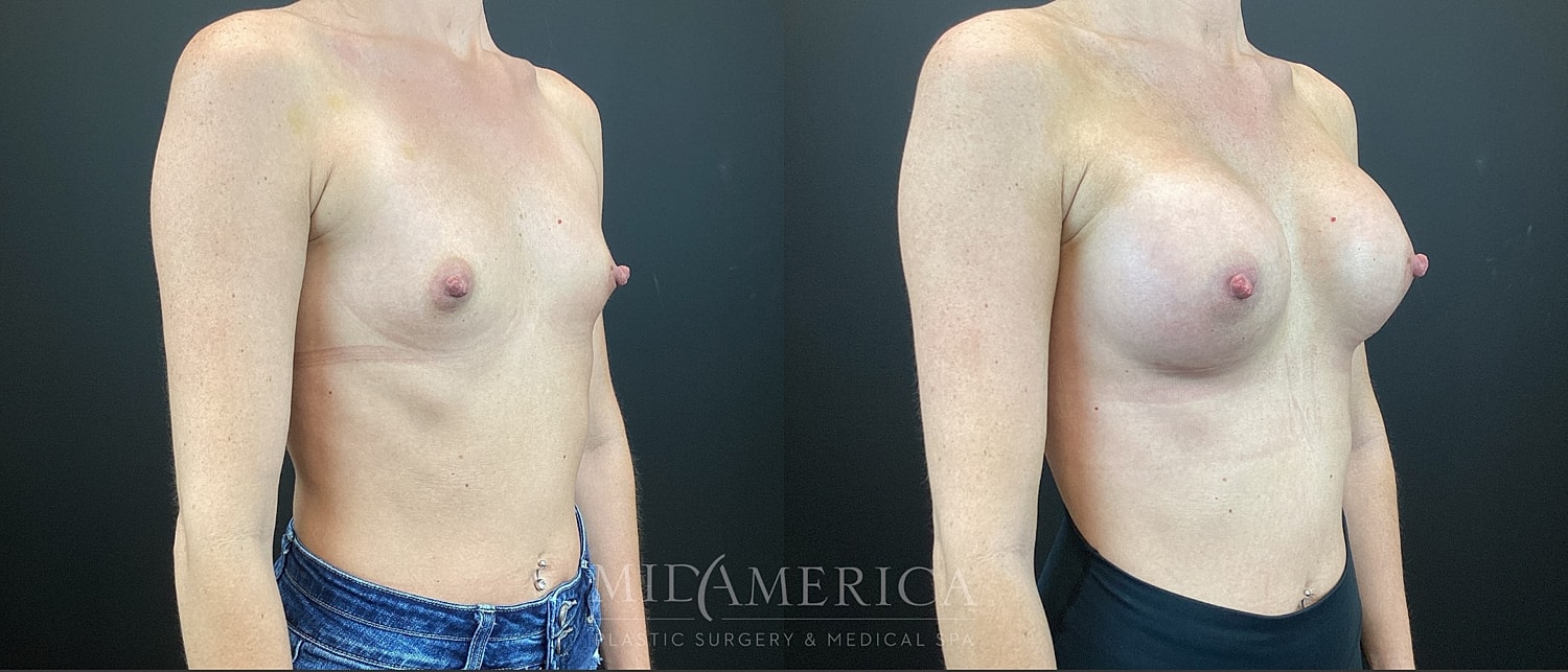 Breast Augmentation Before & After