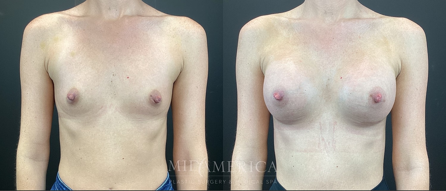 Breast Augmentation Before & After