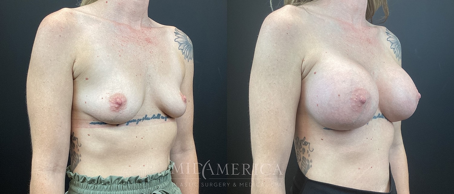 Breast Augmentation Before & After