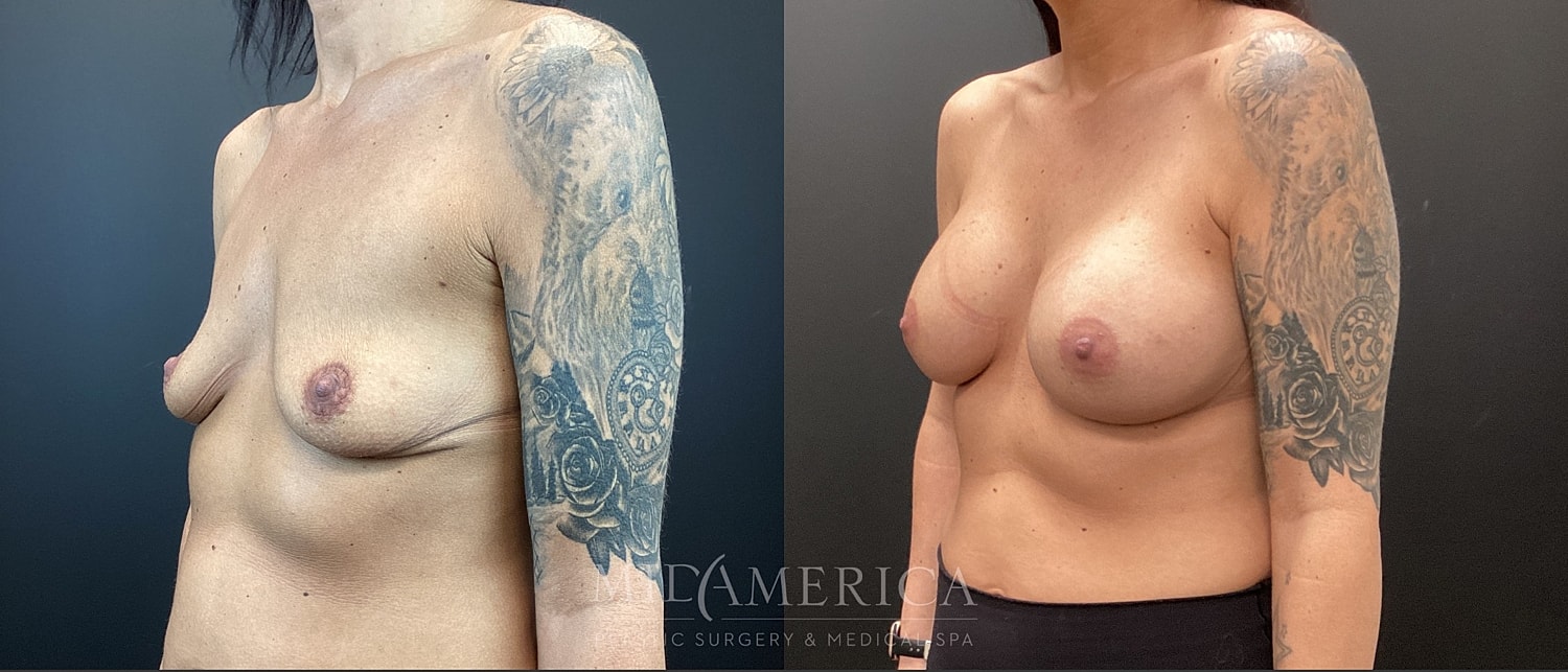 Breast Augmentation Before & After