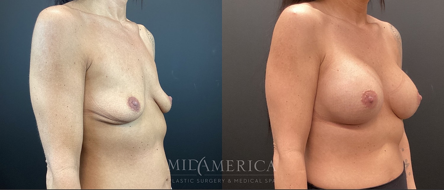 Breast Augmentation Before & After