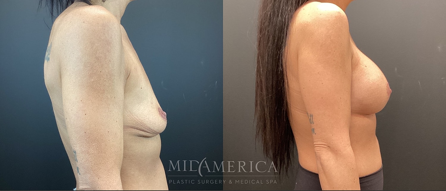 Breast Augmentation Before & After