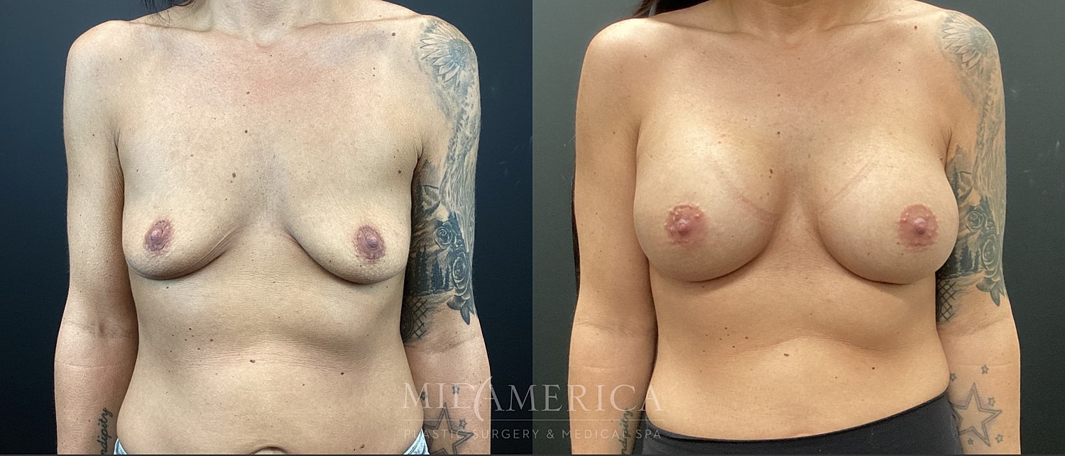 Breast Augmentation Before & After