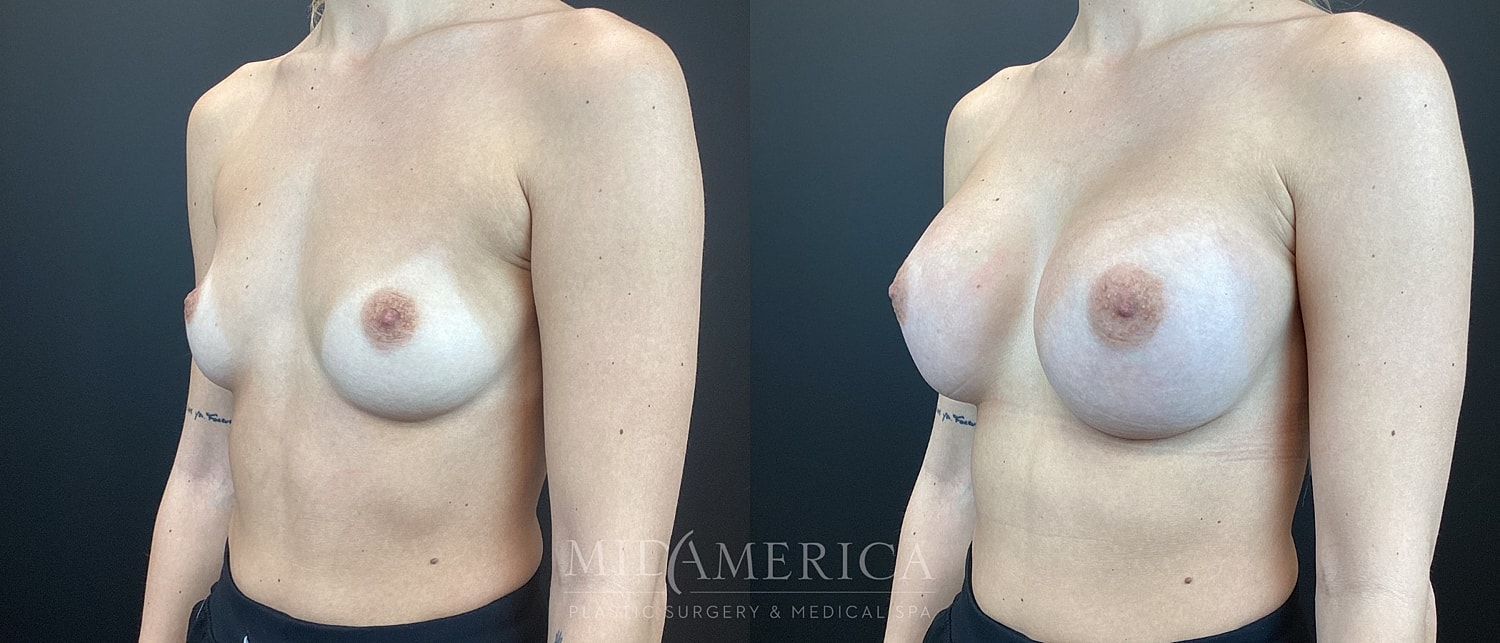 Breast Augmentation Before & After