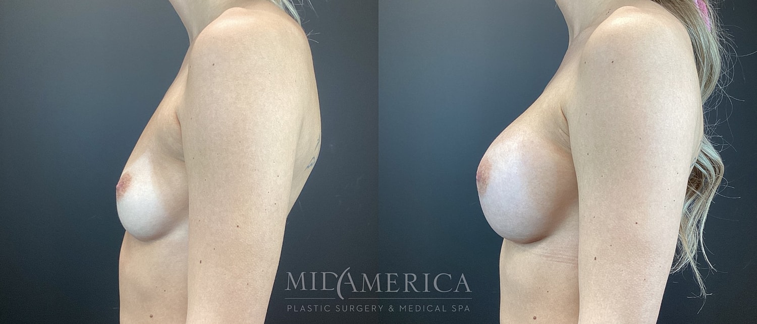 Breast Augmentation Before & After