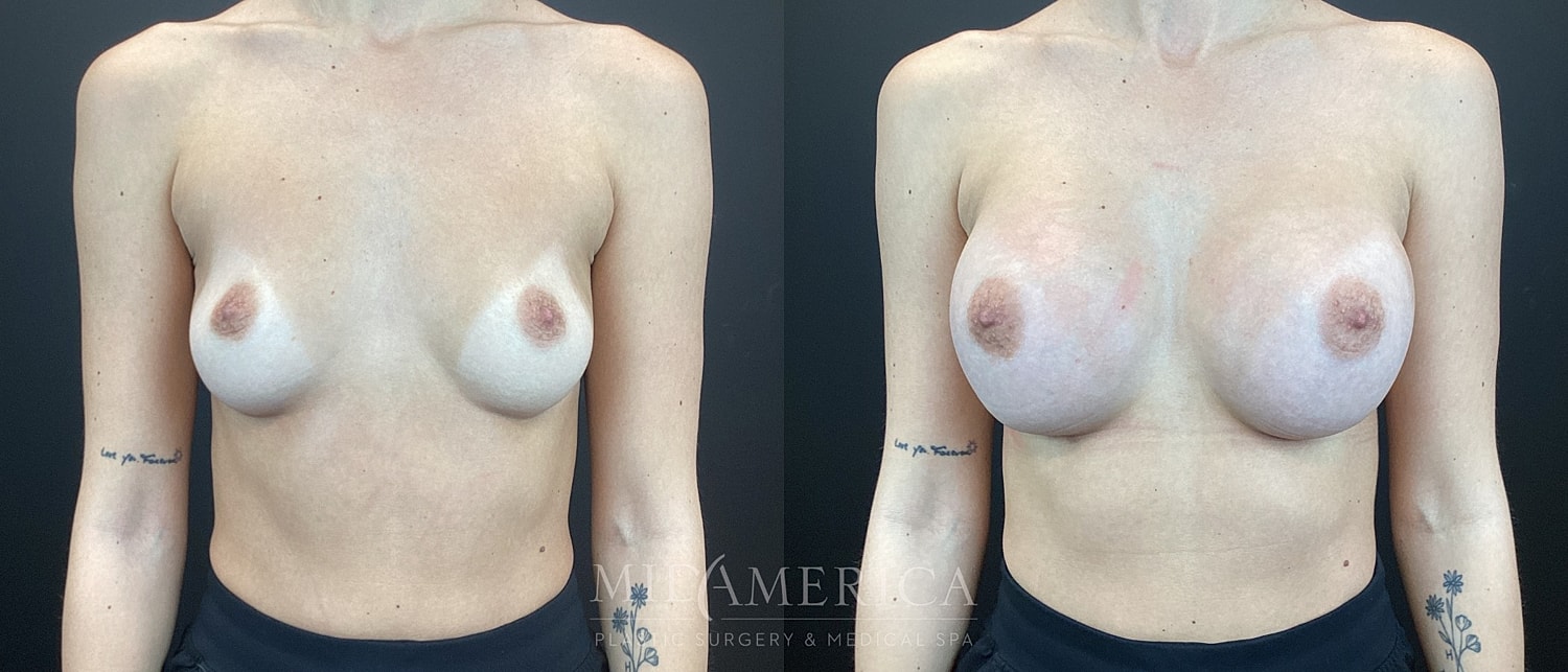 Breast Augmentation Before & After