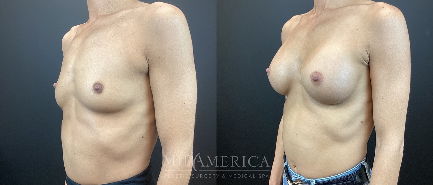 Breast Augmentation Before & After
