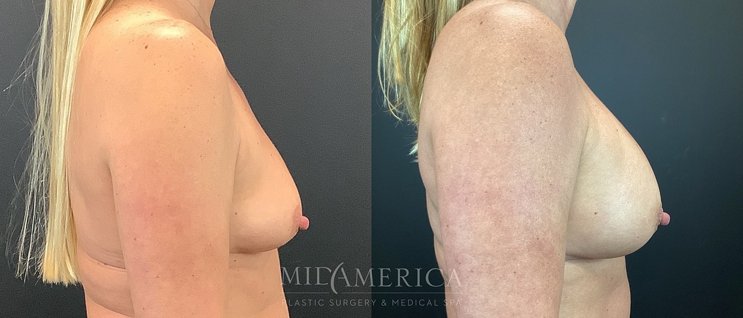 Breast Augmentation Before & After