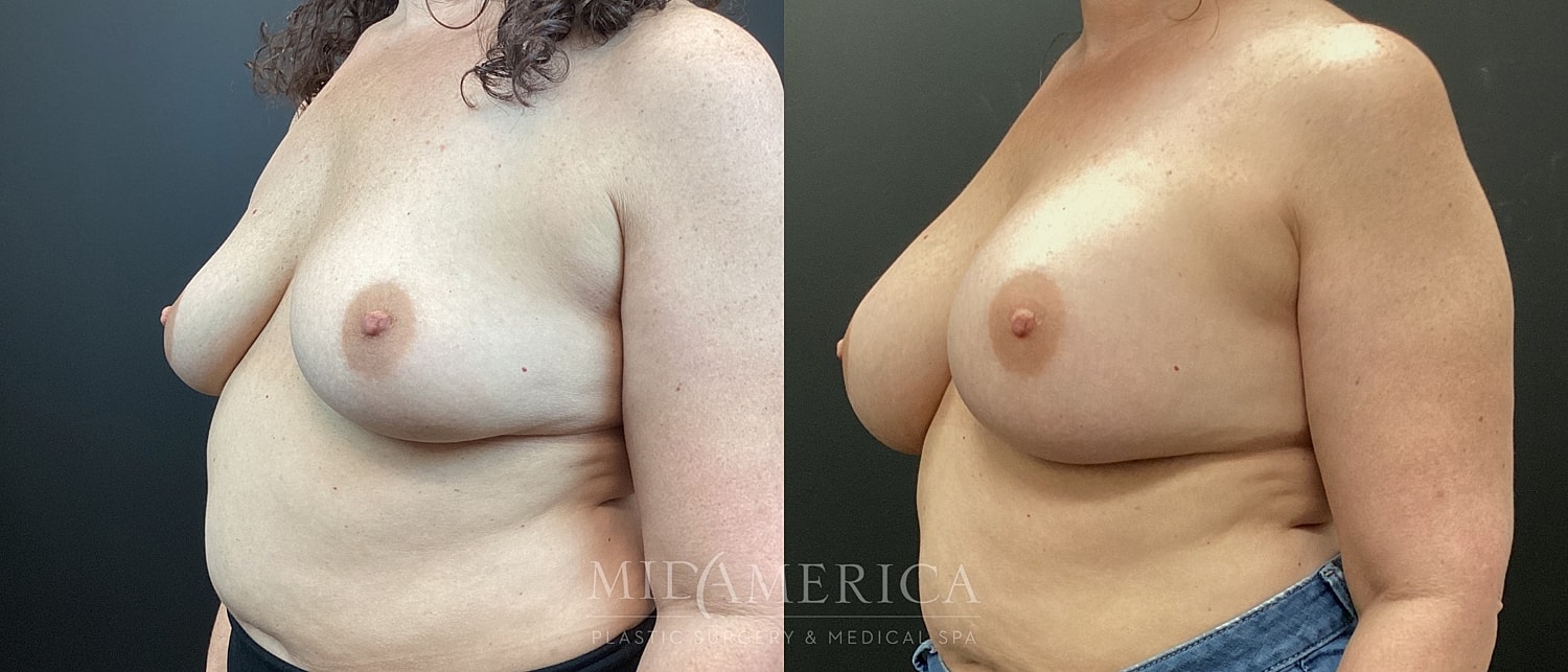 Before and after breast augmentation comparison image.