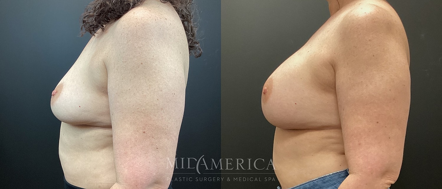Before and after breast enhancement perspective comparison.