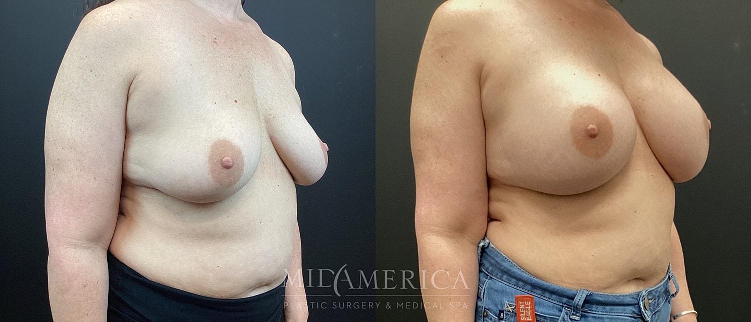 Breast transformation before and after surgery.