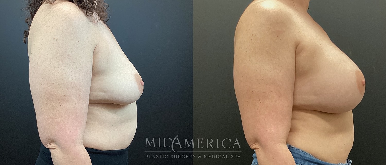 Before and after plastic surgery comparison image.