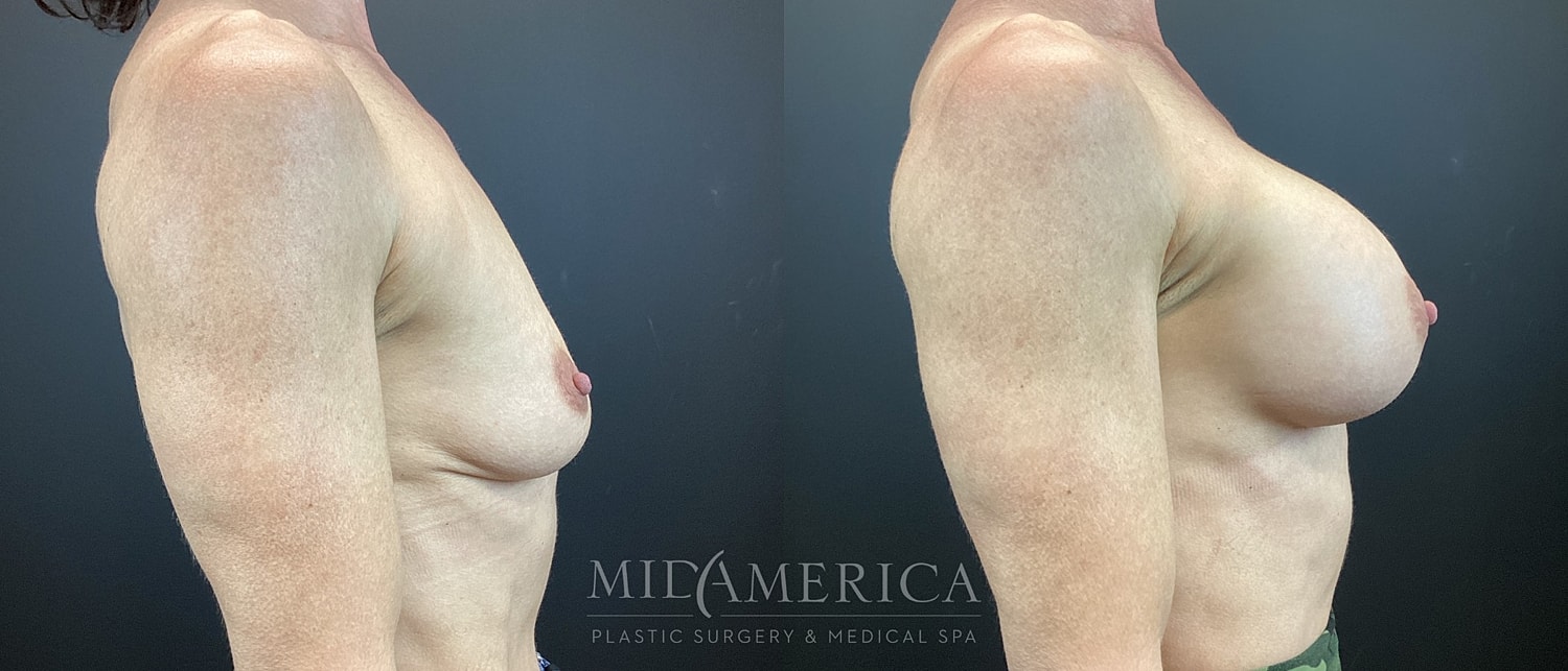 Before and after breast augmentation comparison image.