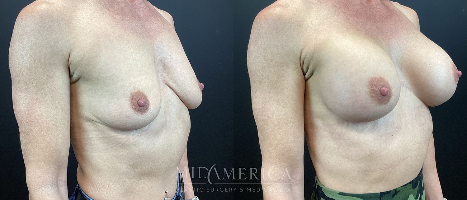 Before and after breast augmentation procedure images.