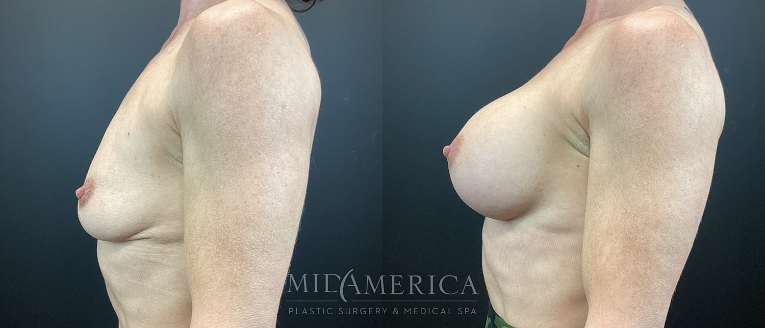 Before-and-after breast augmentation comparison.