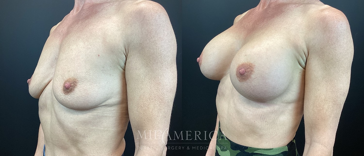 Before and after breast augmentation procedure images.
