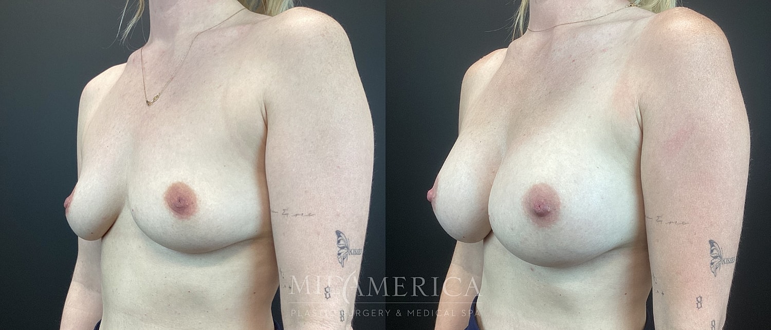Before and after breast enhancement procedure images.