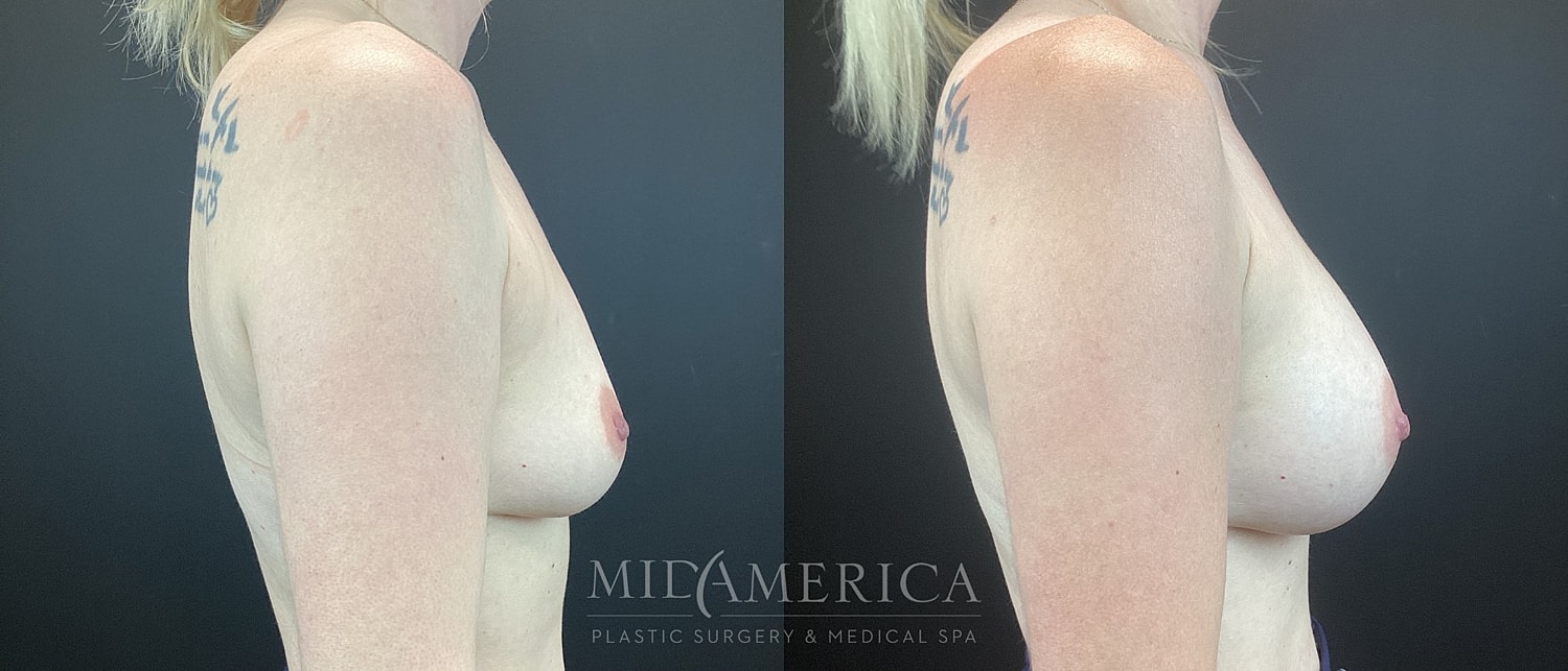Before and after plastic surgery side profile.