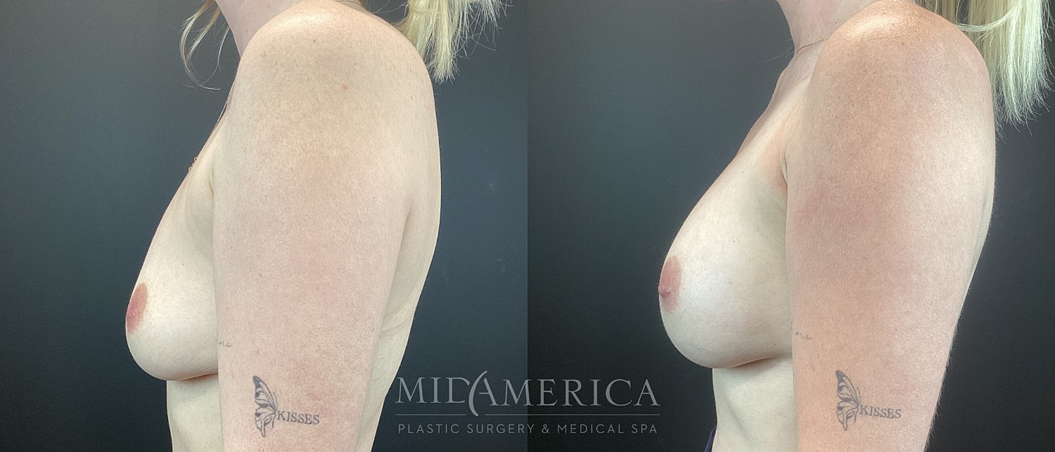 Breast enhancement before and after comparison.