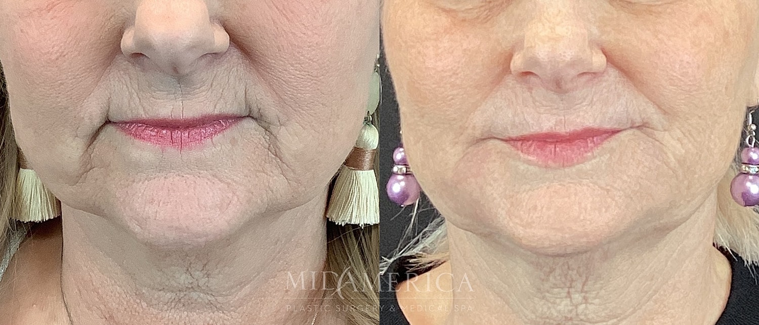 Before and after facial rejuvenation treatment comparison.