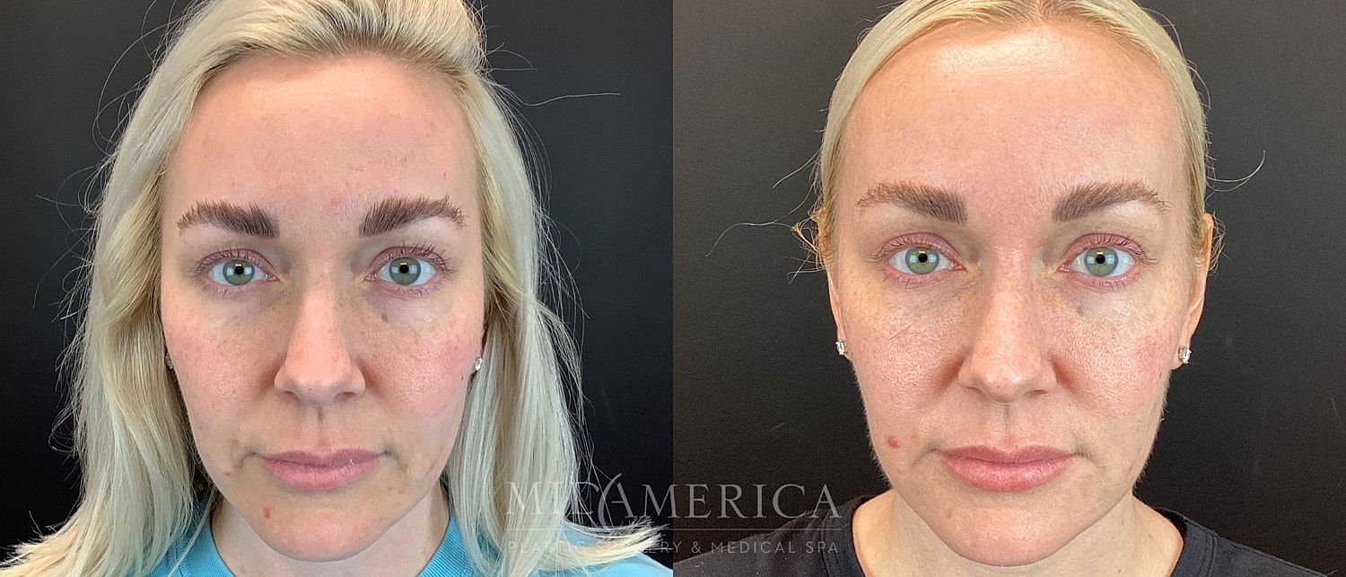 Dermal Fillers Before & After