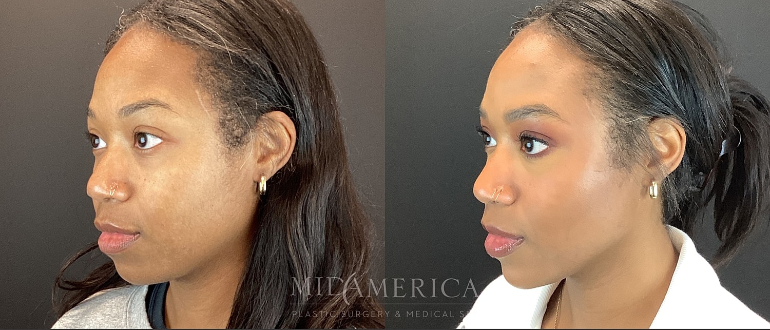 Dermal Fillers Before & After