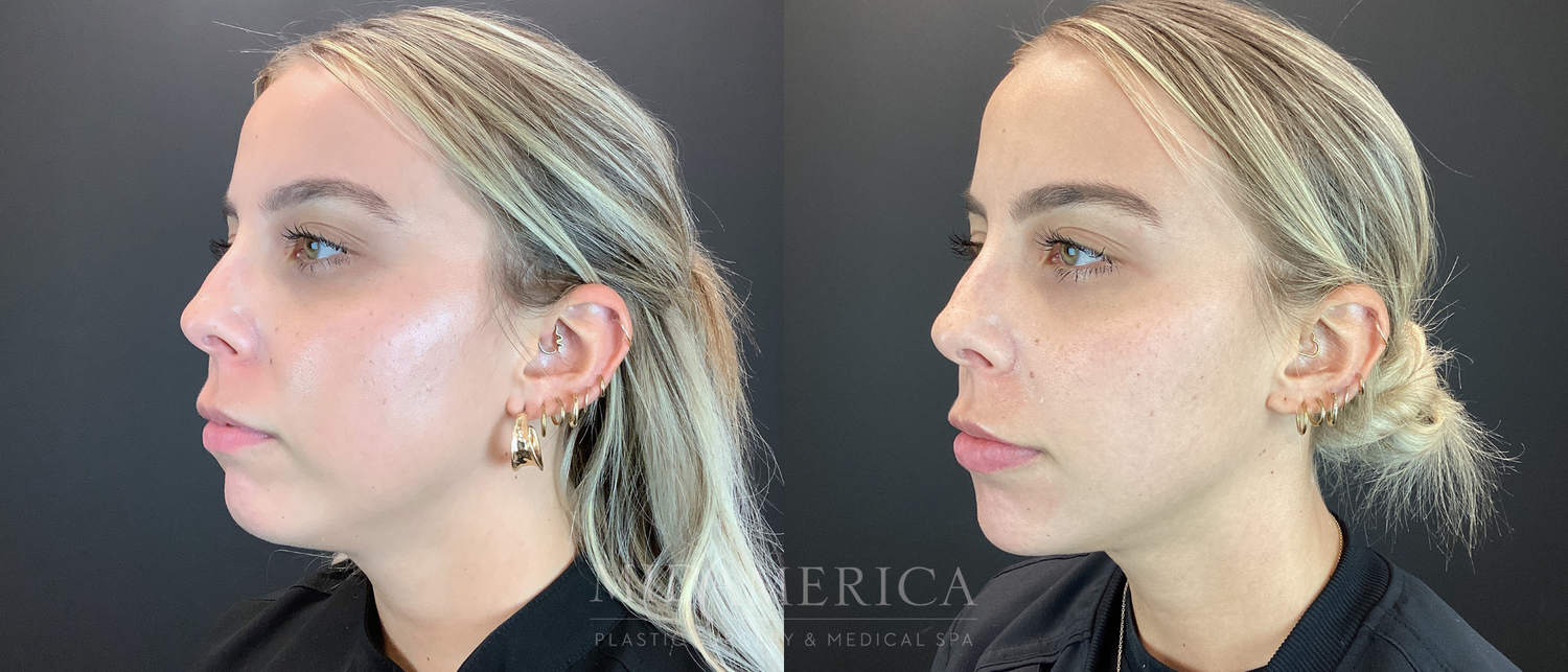 Dermal Fillers Before & After