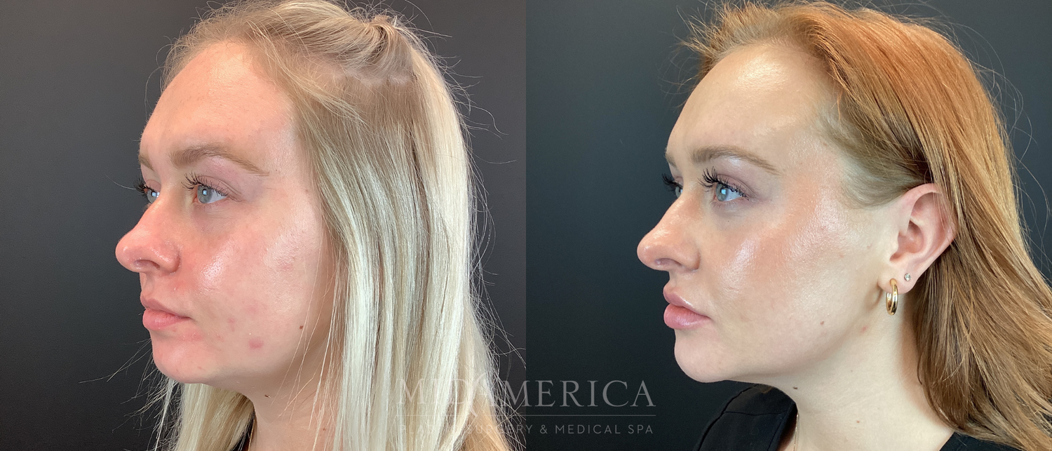 Dermal Fillers Before & After