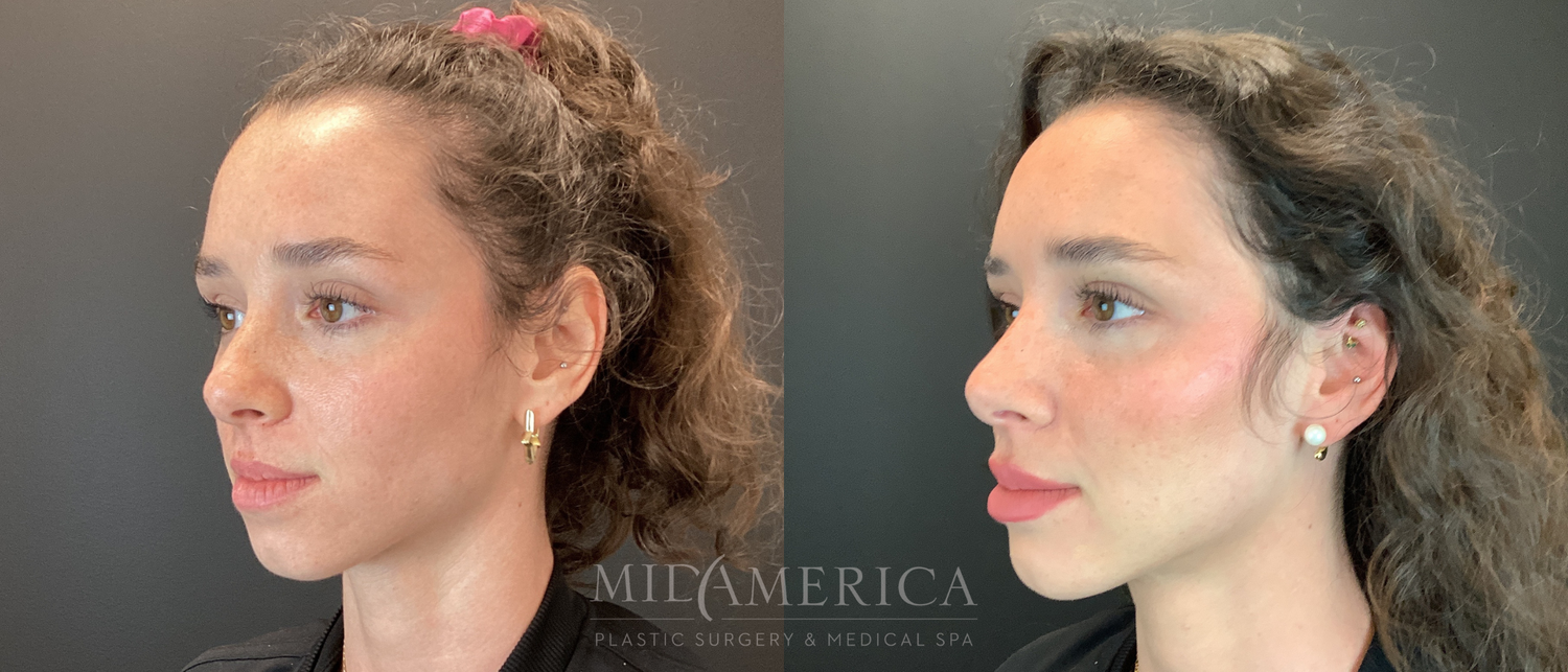Dermal Fillers Before & After