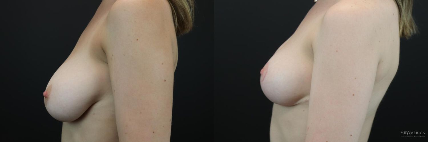 Breast Reduction Before & After