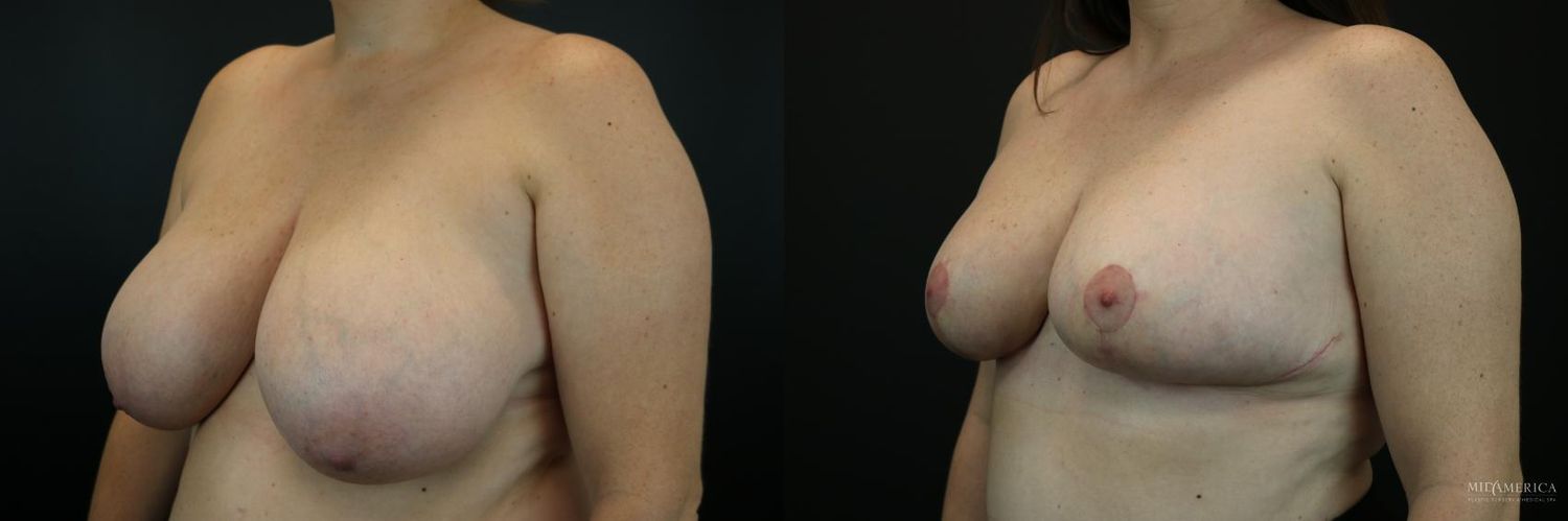 Breast Reduction Before & After