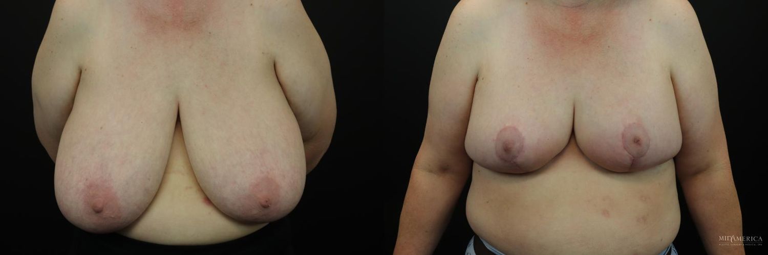 Breast Reduction Before & After