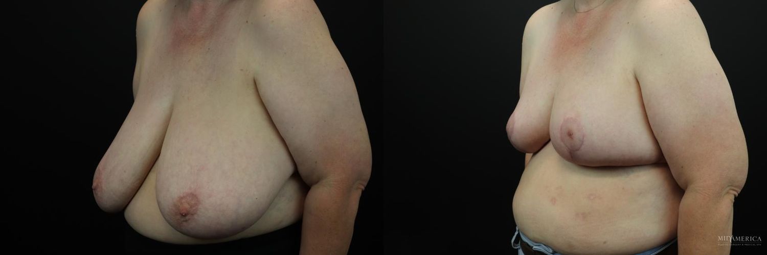 Breast Reduction Before & After