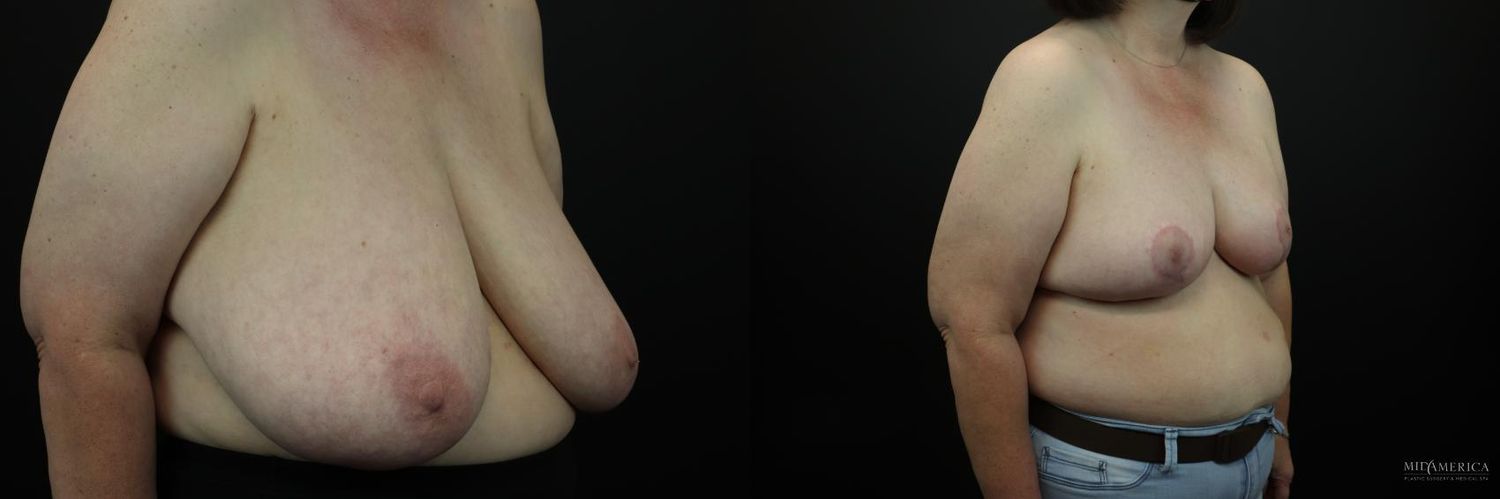 Breast Reduction Before & After