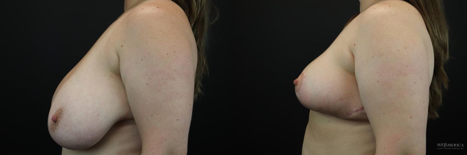 Breast Reduction Before & After