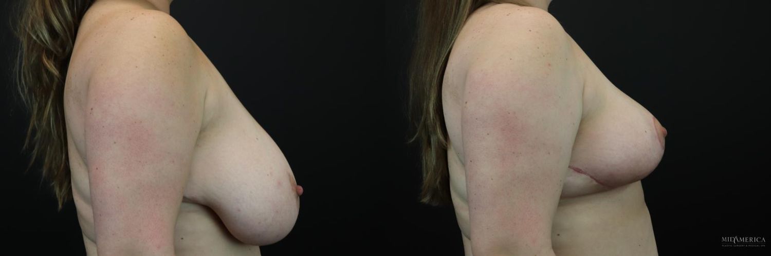 Breast Reduction Before & After