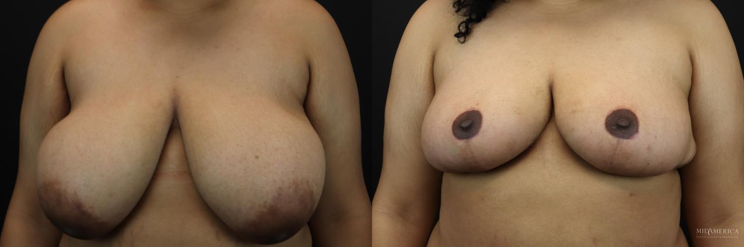 Breast Reduction Before & After