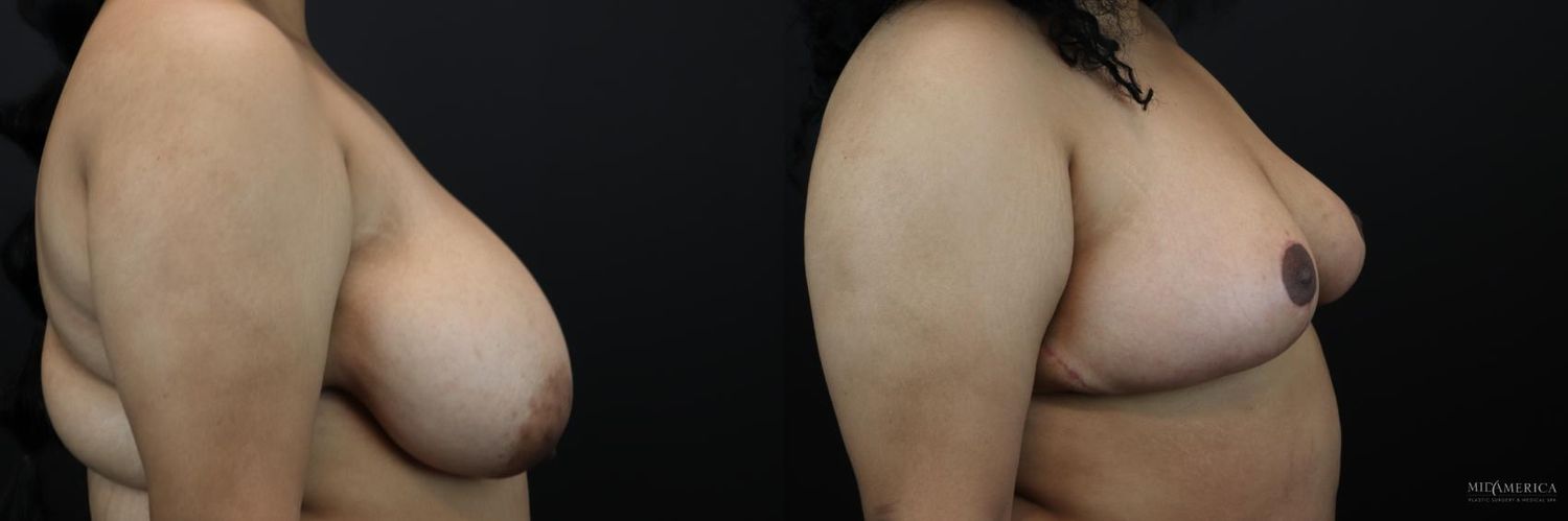 Breast Reduction Before & After