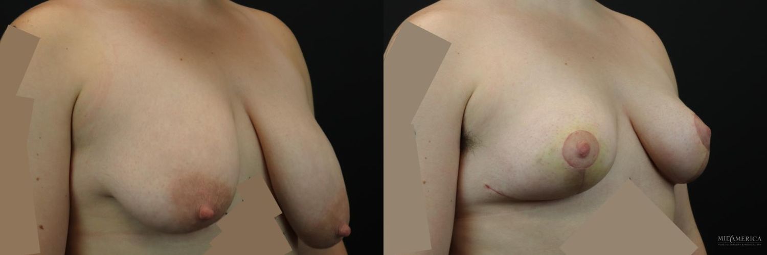 Breast Reduction Before & After