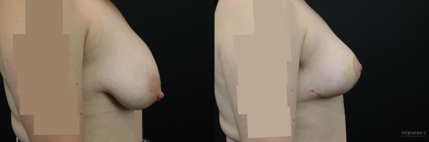 Breast Reduction Before & After