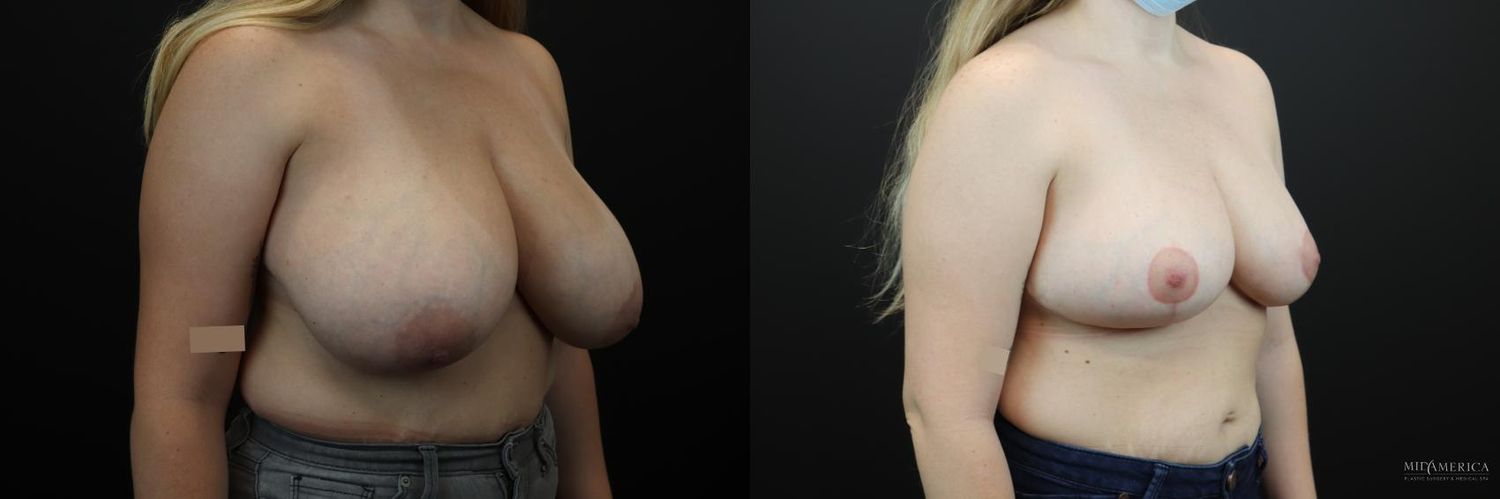 Breast Reduction Before & After